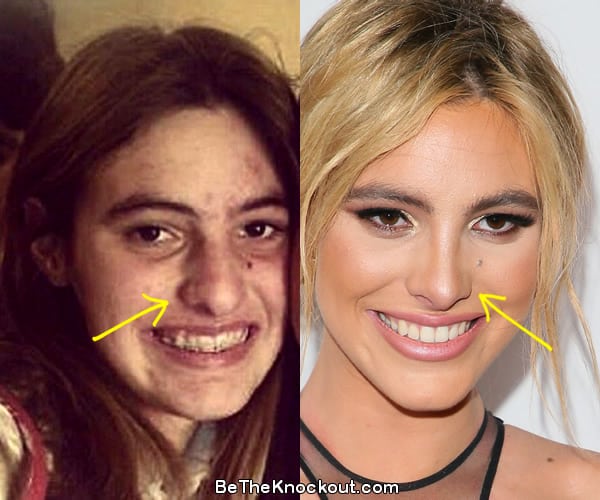 Lele Pons nose job before and after comparison photo