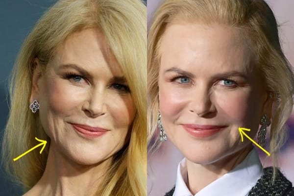 Nicole Kidman botox before and after comparison photo
