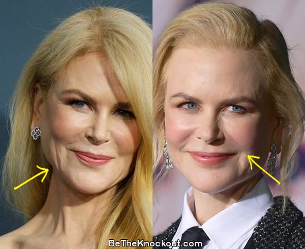 Nicole Kidman botox before and after comparison photo