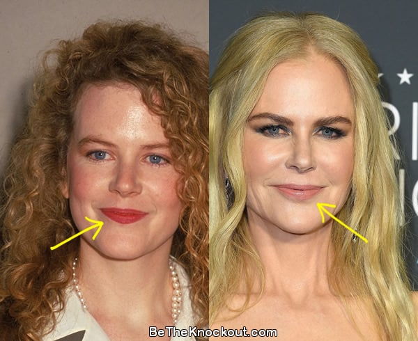Nicole Kidman lip fillers before and after comparison photo