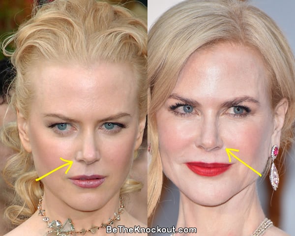 Nicole Kidman nose job before and after comparison photo