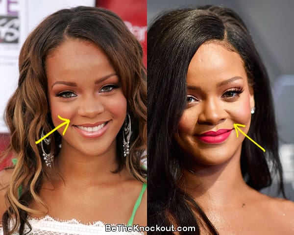 Rihanna nose job before and after comparison photo