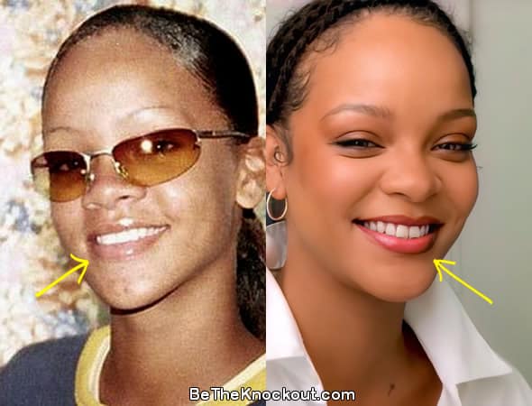 Rihanna teeth before and after comparison photo