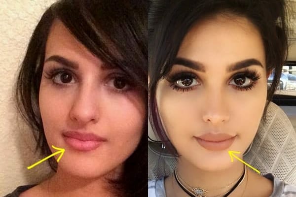 SSSniperwolf lip injections before and after comparison photo