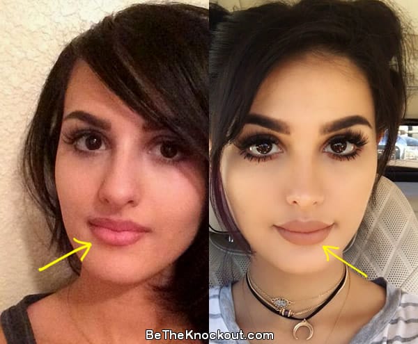 SSSniperwolf lip injections before and after comparison photo