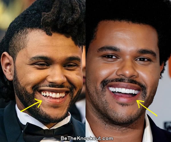 The Weeknd teeth before and after comparison