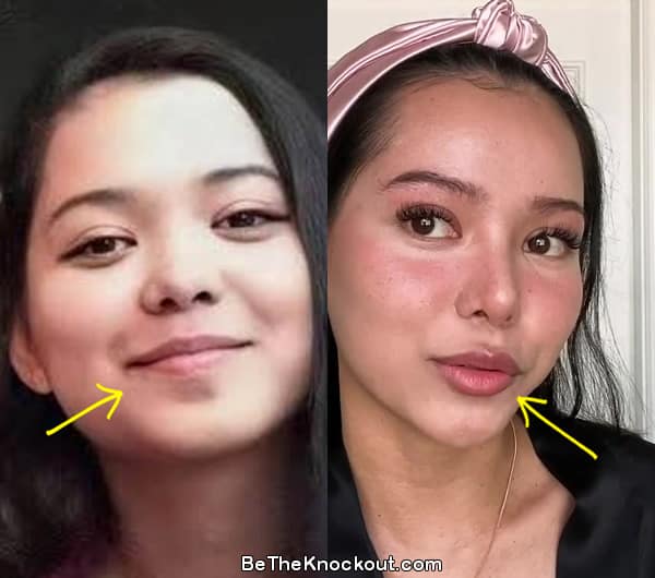 Bella Poarch lip injections before and after comparison photo