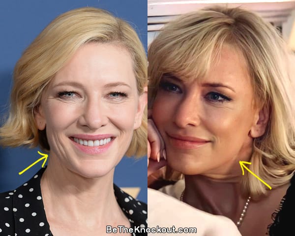 Cate Blanchett botox before and after comparison photo