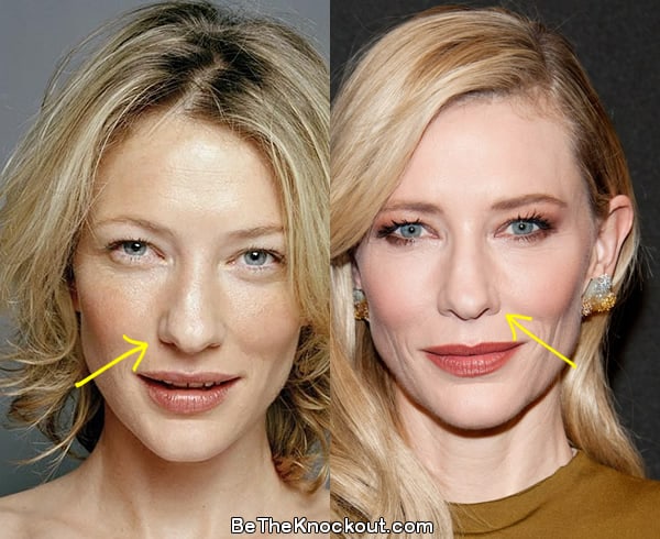 Cate Blanchett nose job before and after comparison photo