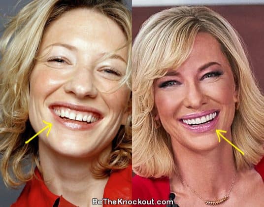 Kate Coll Teeth Cate Blanchett Plastic Surgery Comparison Photos