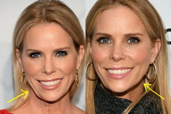 Cheryl Hines botox before and after comparison photo