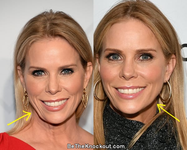 Cheryl Hines botox before and after comparison photo