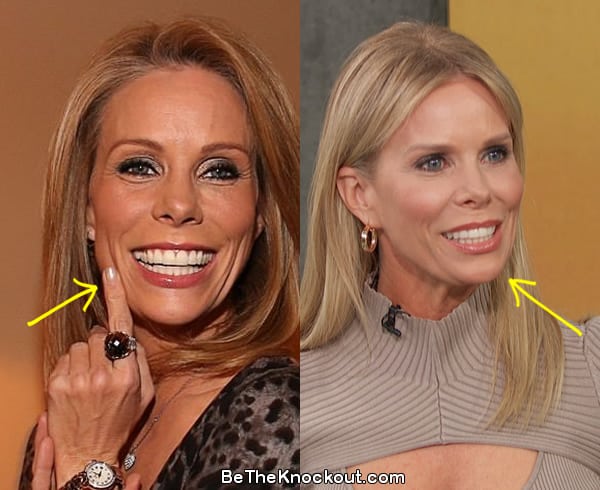 Cheryl Hines facelift before and after comparison photo