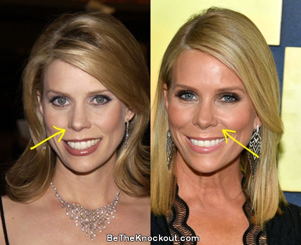 Cheryl Hines nose job before and after comparison photo