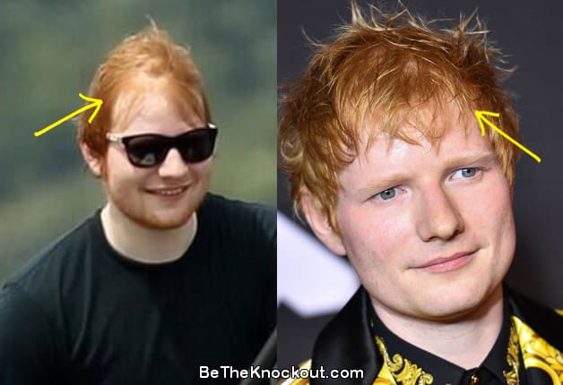 Ed Sheeran hair transplant before and after comparison photo