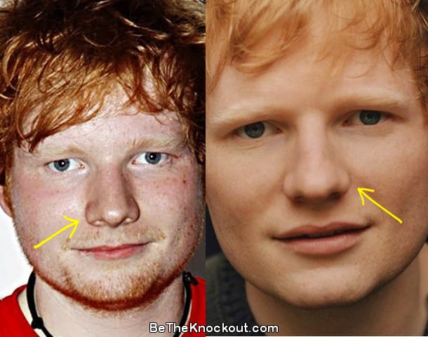 Ed Sheeran nose job before and after comparison photo