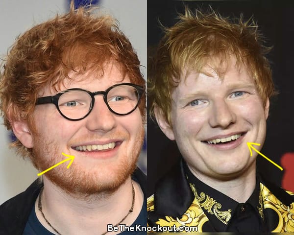 Ed Sheeran teeth before and after comparison photo