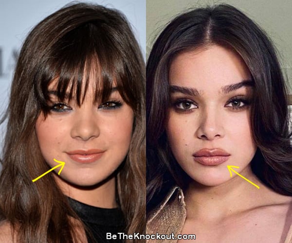 Hailee Steinfeld lip injections before and after comparison photo