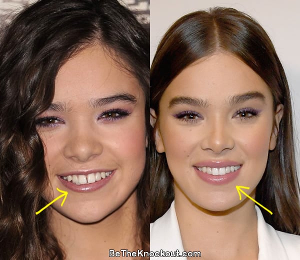 Hailee Steinfeld teeth before and after comparison photo