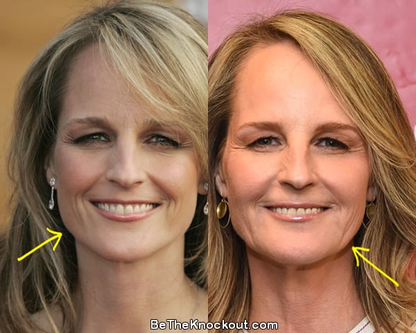 Helen Hunt botox before and after comparison photo
