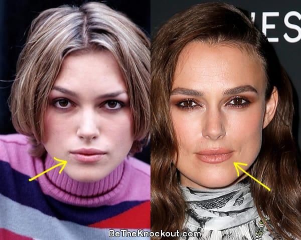 Keira Knightley lip fillers before and after comparison photo