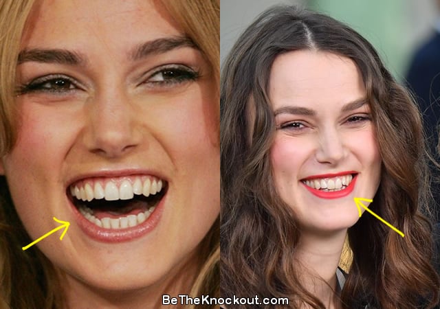 Keira Knightley teeth before and after comparison photo