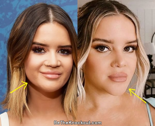 Maren Morris botox before and after comparison photo