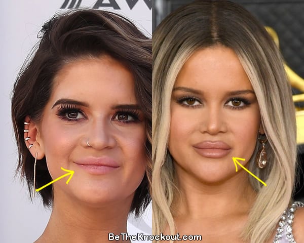 Maren Morris lip injections before and after comparison photo