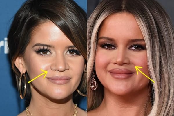 Maren Morris nose job before and after comparison photo