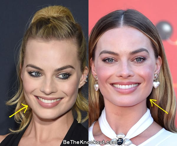 Margot Robbie botox before and after comparison photo