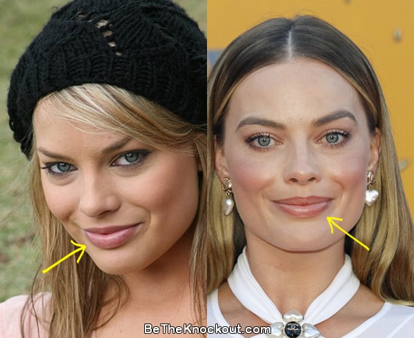 Margot Robbie lip fillers before and after comparison photo
