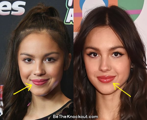 Olivia Rodrigo lip fillers before and after comparison photo