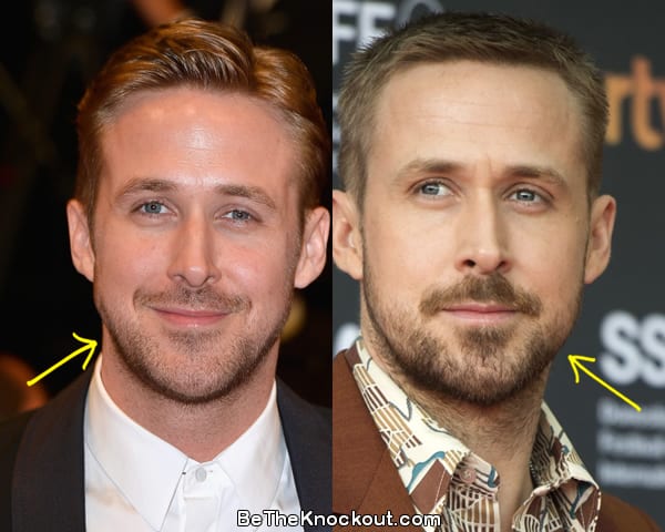 Ryan Gosling botox before and after comparison photo