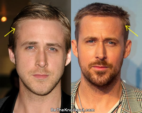 Ryan Gosling hair transplant before and after comparison photo