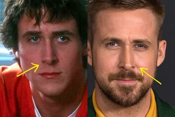 Ryan Gosling nose job before and after comparison photo