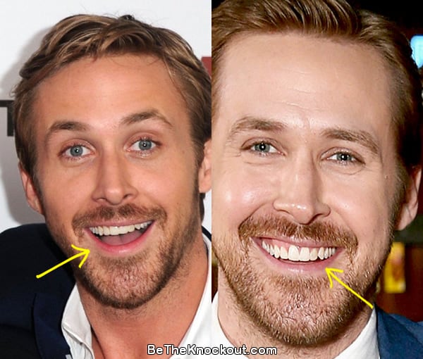 Ryan Gosling teeth before and after comparison photo