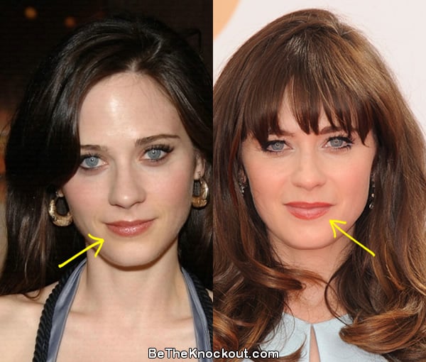 Zooey Deschanel lip fillers before and after comparison photo