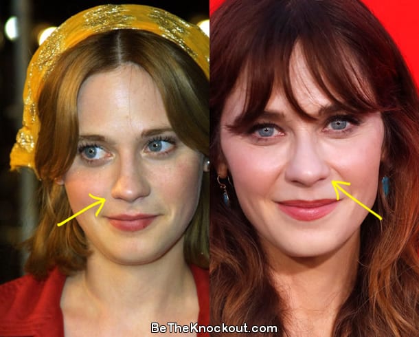 Zooey Deschanel nose job before and after comparison photo
