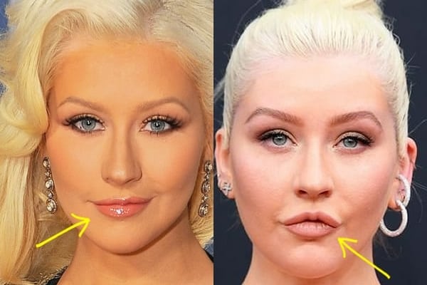 Christina Aguilera lip fillers before and after comparison photo