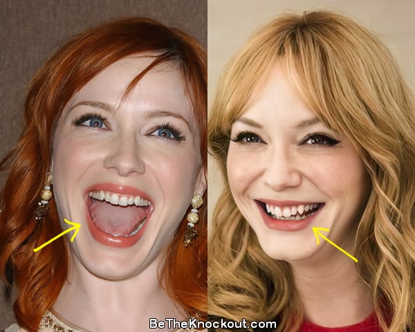 Christina Hendricks teeth before and after comparison photo