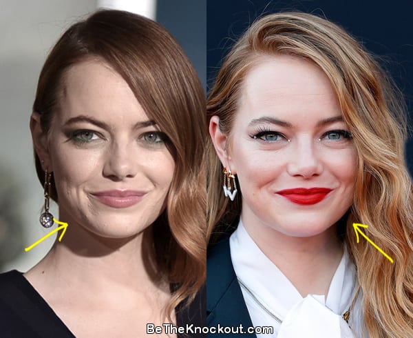 Emma Stone botox before and after comparison photo