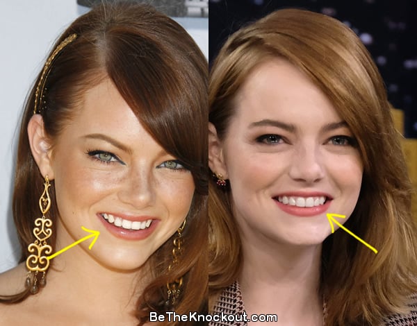 Emma Stone teeth before and after comparison photo