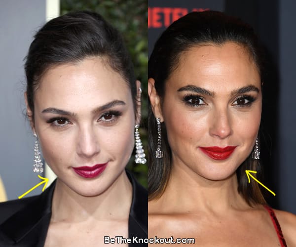 Gal Gadot botox before and after comparison photo