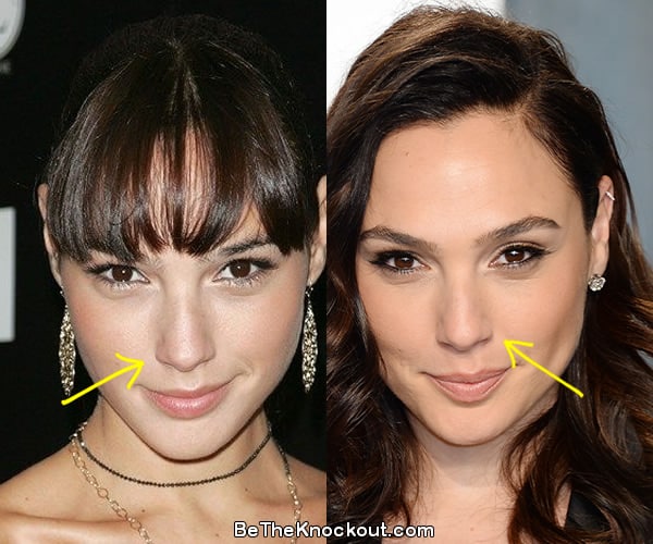 Gal Gadot nose job before and after comparison photo