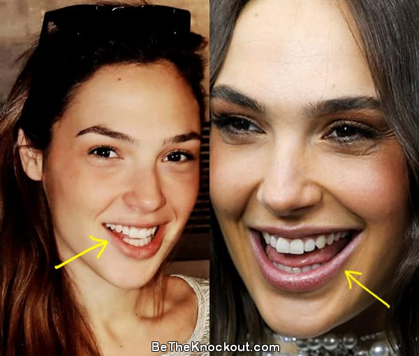 Gal Gadot teeth before and after comparison photo