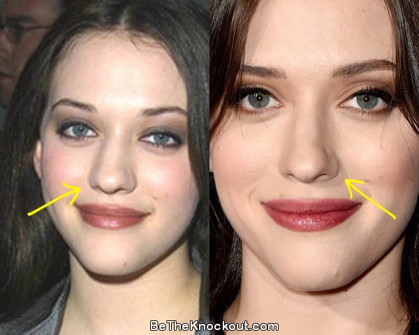 Kat Dennings nose job before and after comparison photo