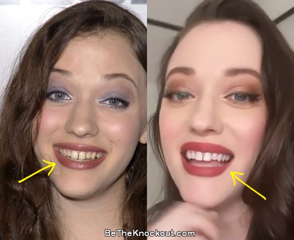 Kat Dennings teeth before and after comparison photo