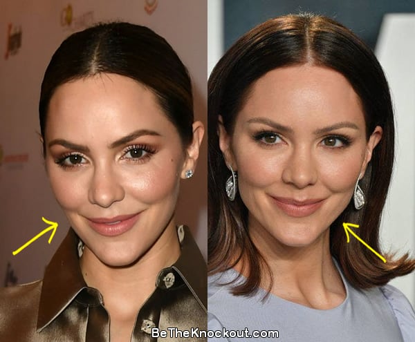Katharine Mcphee botox before and after comparison photo