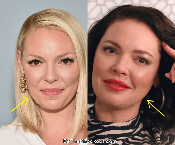 Katherine Heigl facelift before and after comparison photo