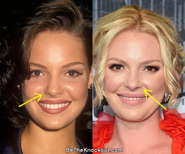Katherine Heigl nose job before and after comparison photo